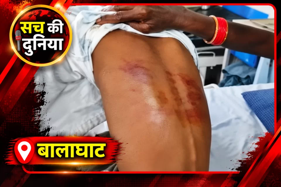 बालाघाट में शिक्षक की बेरहमी का आरोप: गणित का सवाल हल नहीं कर पाया पांचवीं का छात्र, डंडे से पिटाई के बाद अस्पताल में भर्ती
